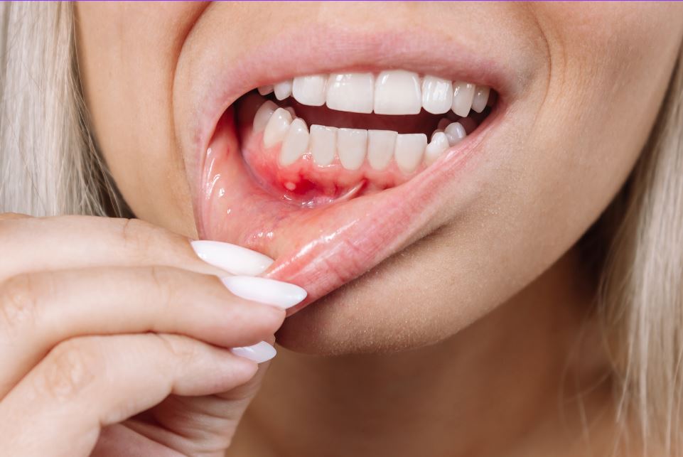 Understanding Periodontitis: Causes, Symptoms, and Treatment Options