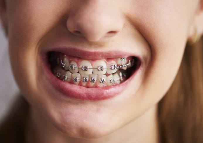 Lingual Orthodontics: An Overview Of Invisible Braces