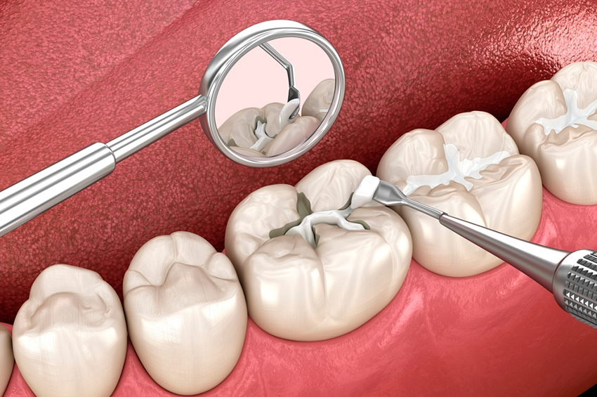 A Guide to Dental Fillings
