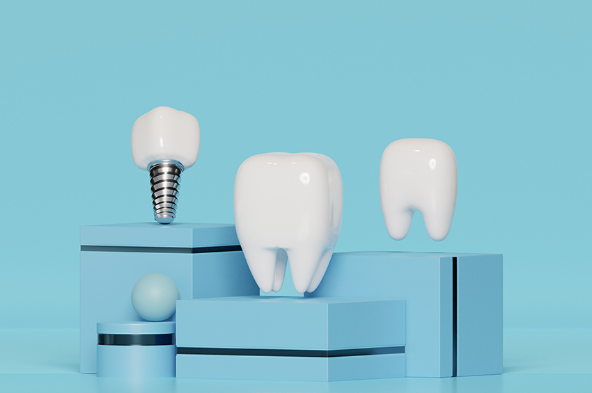 Dental Implant Journey: Understanding Each Stage for Successful Tooth Replacement