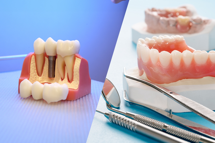 Dental Implants vs. Dentures: Which is Right?
