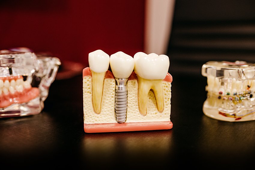 5 Dental Options for Replacing Missing Teeth
