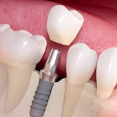 Dental implant in dwarka