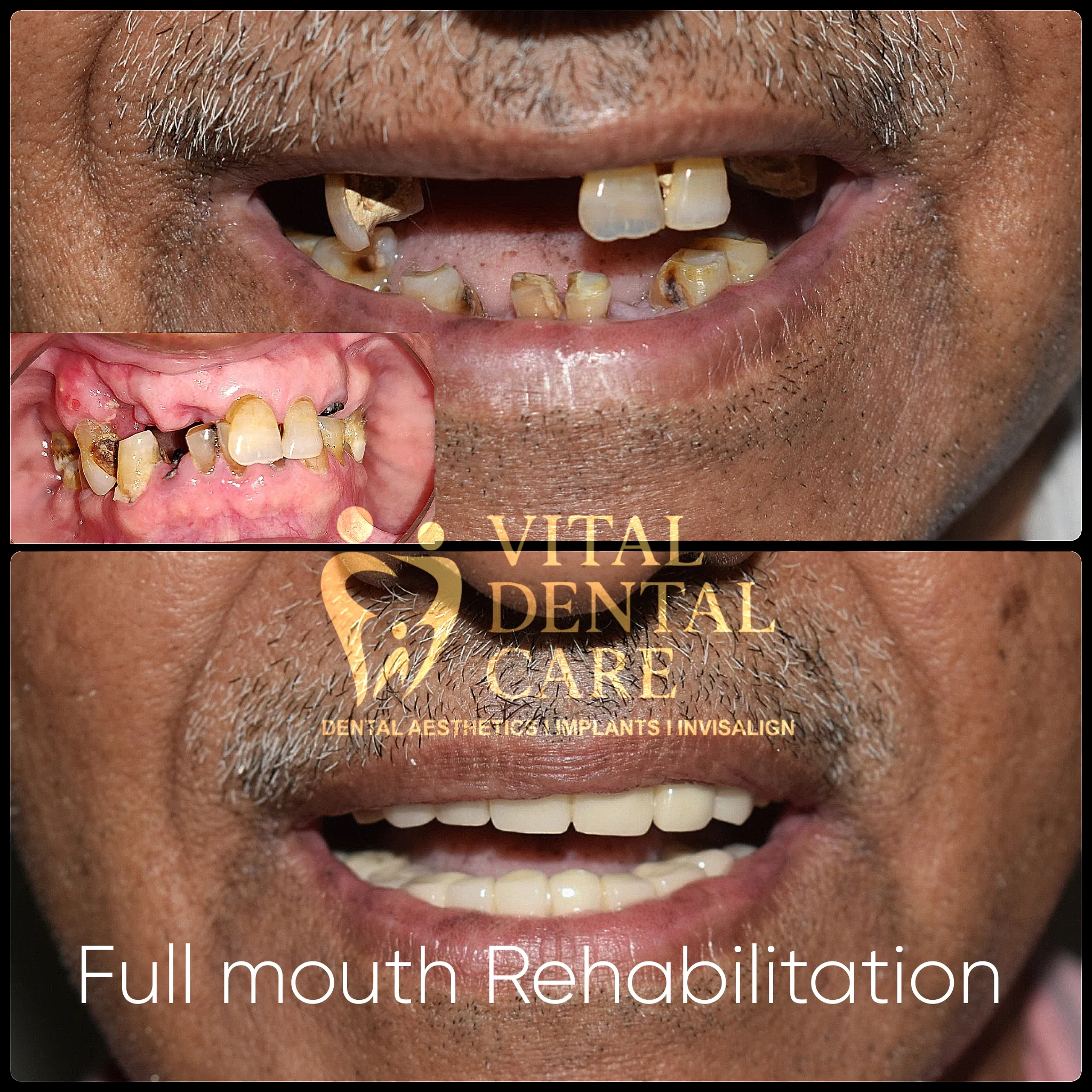 Treatment: Full Mouth Implants - Before and After Smile Transformation