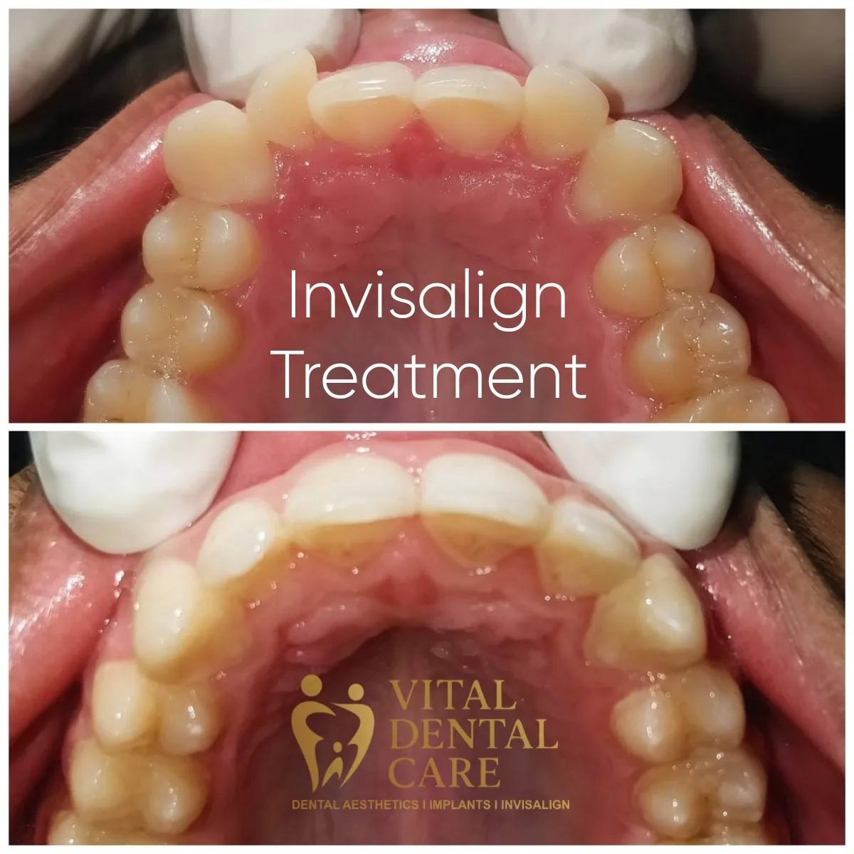Treatment: Clear Aligners - Before and After Smile Transformation