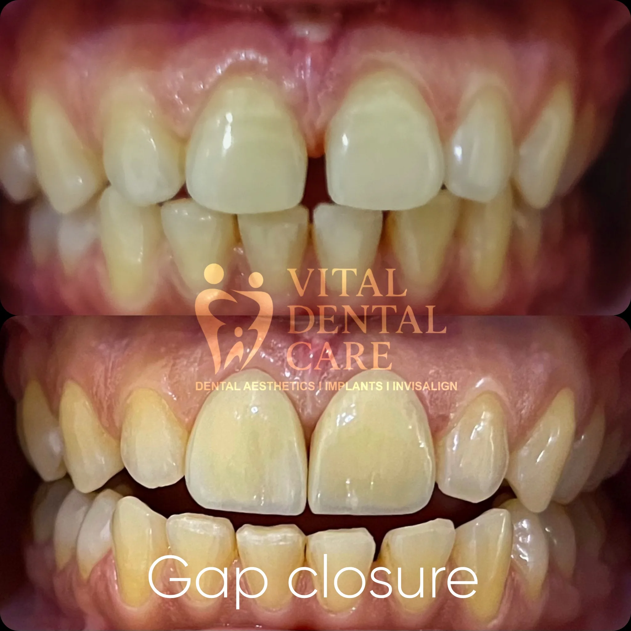 Treatment: Aesthetic Smile Makeover - Before and After Smile Transformation